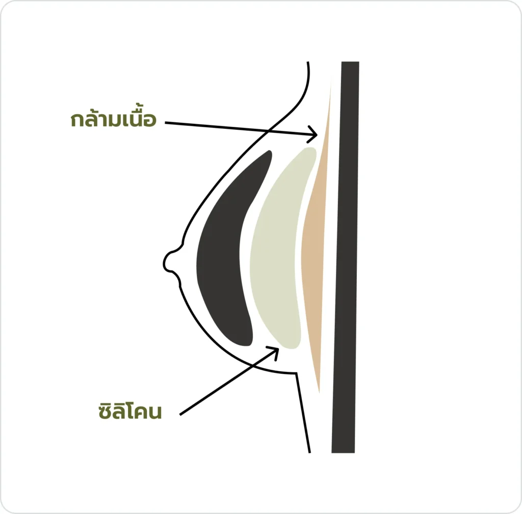 ตำแหน่งวางซิลิโคนแบบที่ 1