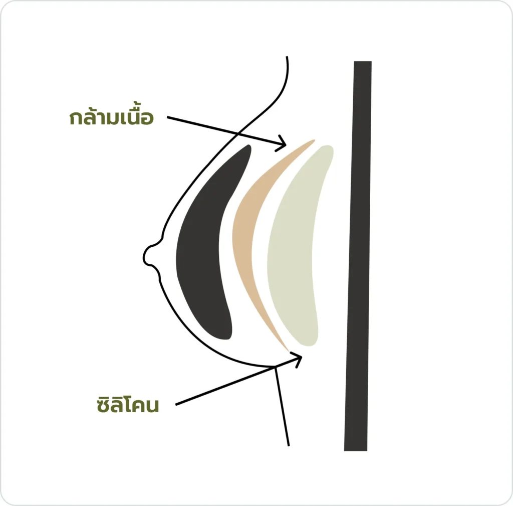 ตำแหน่งวางซิลิโคนแบบที่ 2