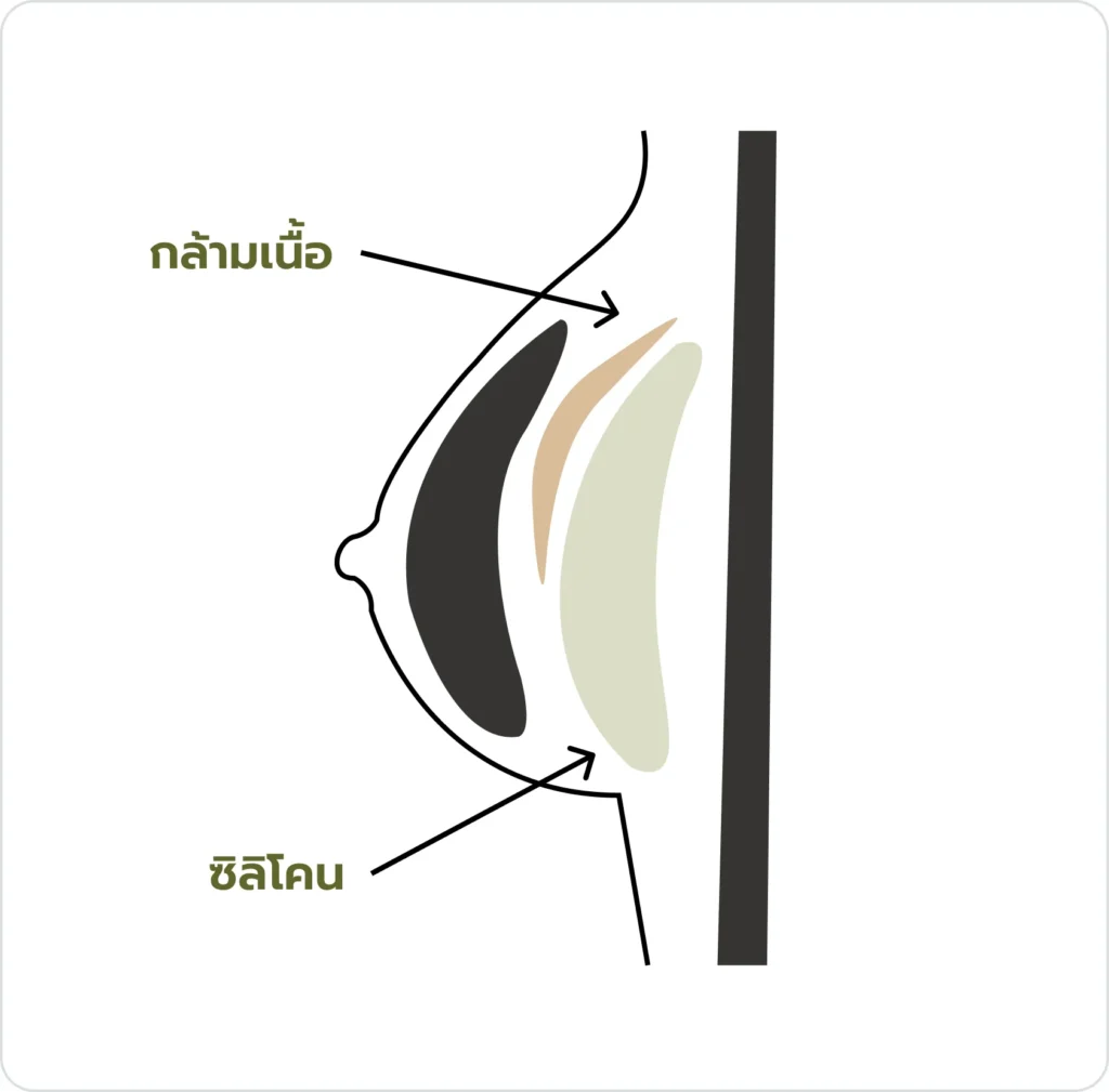 ตำแหน่งวางซิลิโคนแบบที่ 3