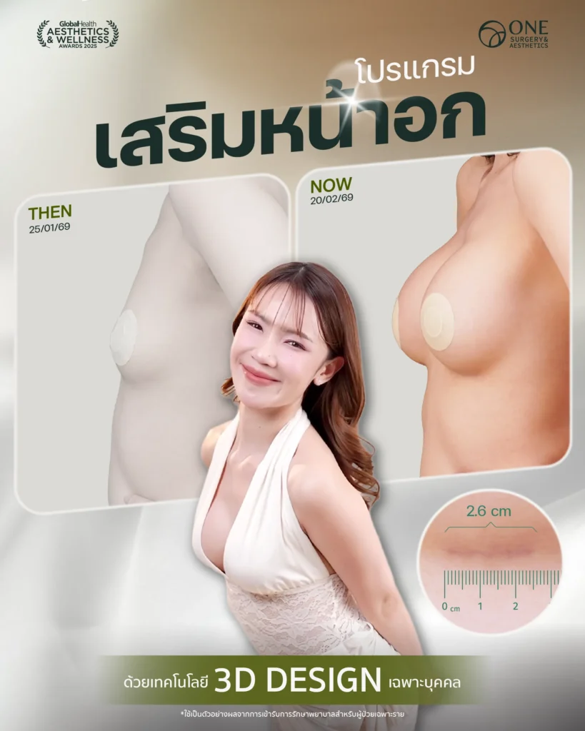 รวมรีวิวเสริมหน้าอก Final Web-06