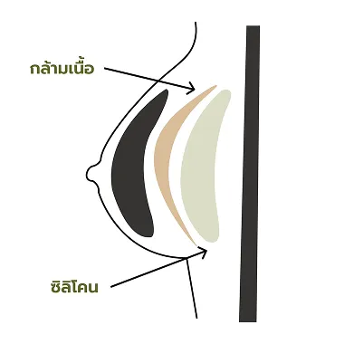 ใต้กล้ามเนื้อ