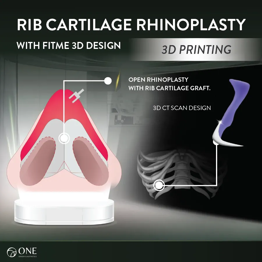 02 Rib Cartilage Phinoplasty-01_11zon