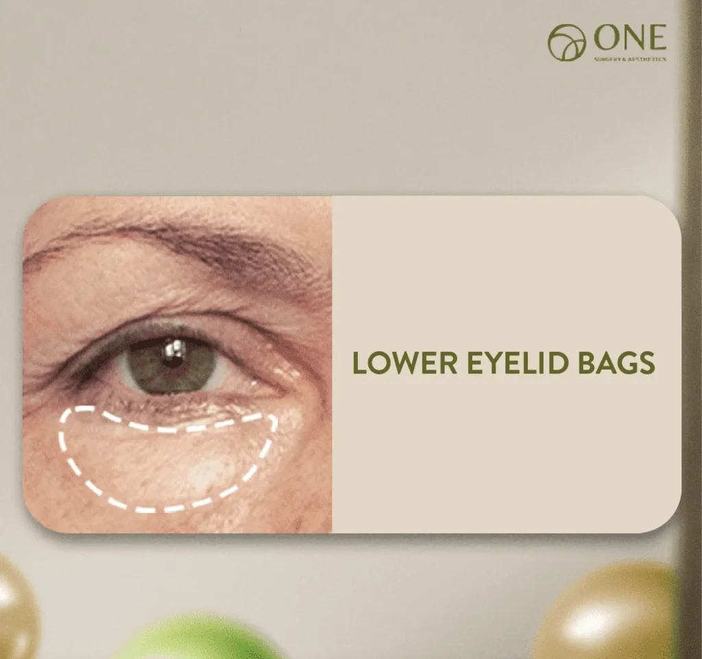 06 Lower Eyelid Bags-01