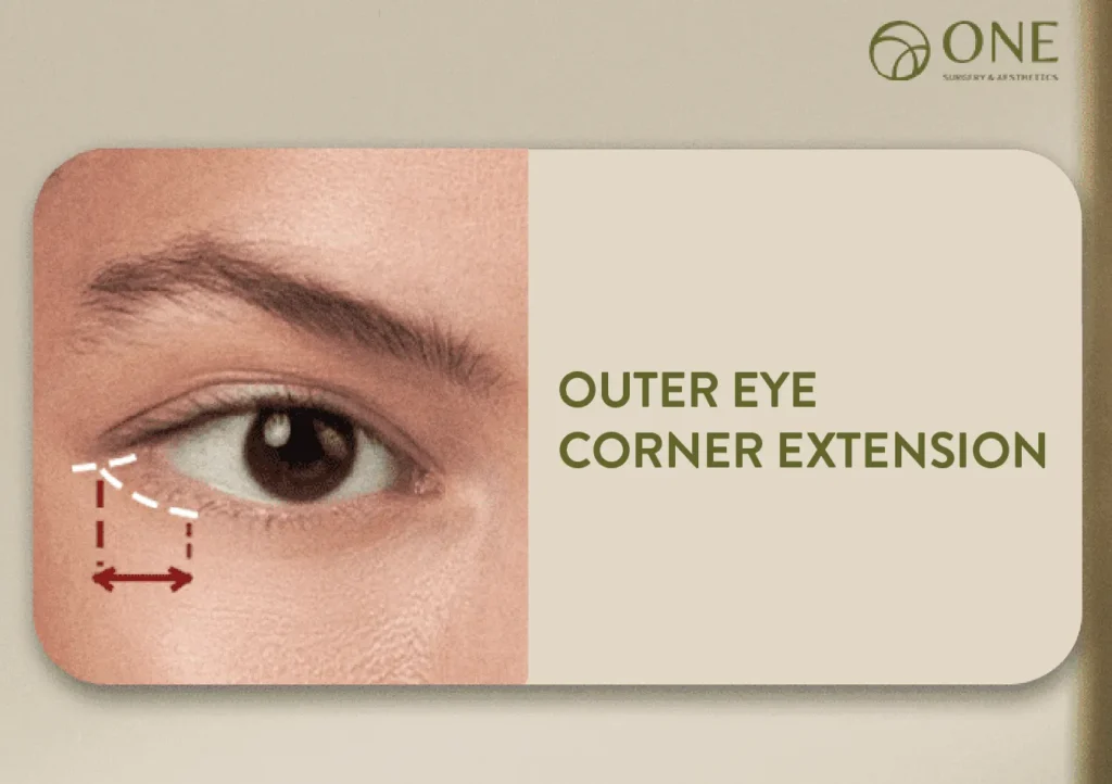 07 Outer eye corner extension-01