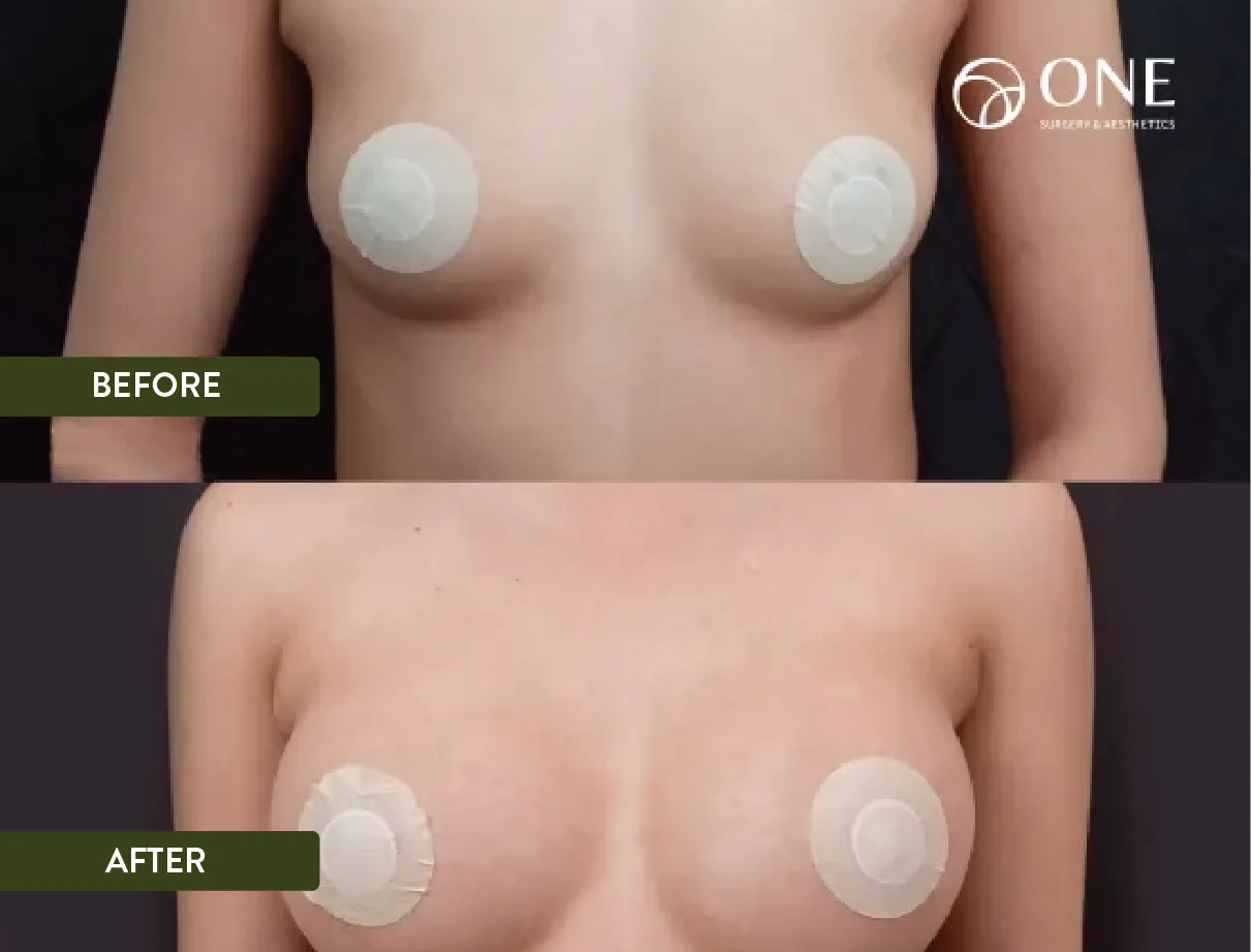 09 Breast Augmention