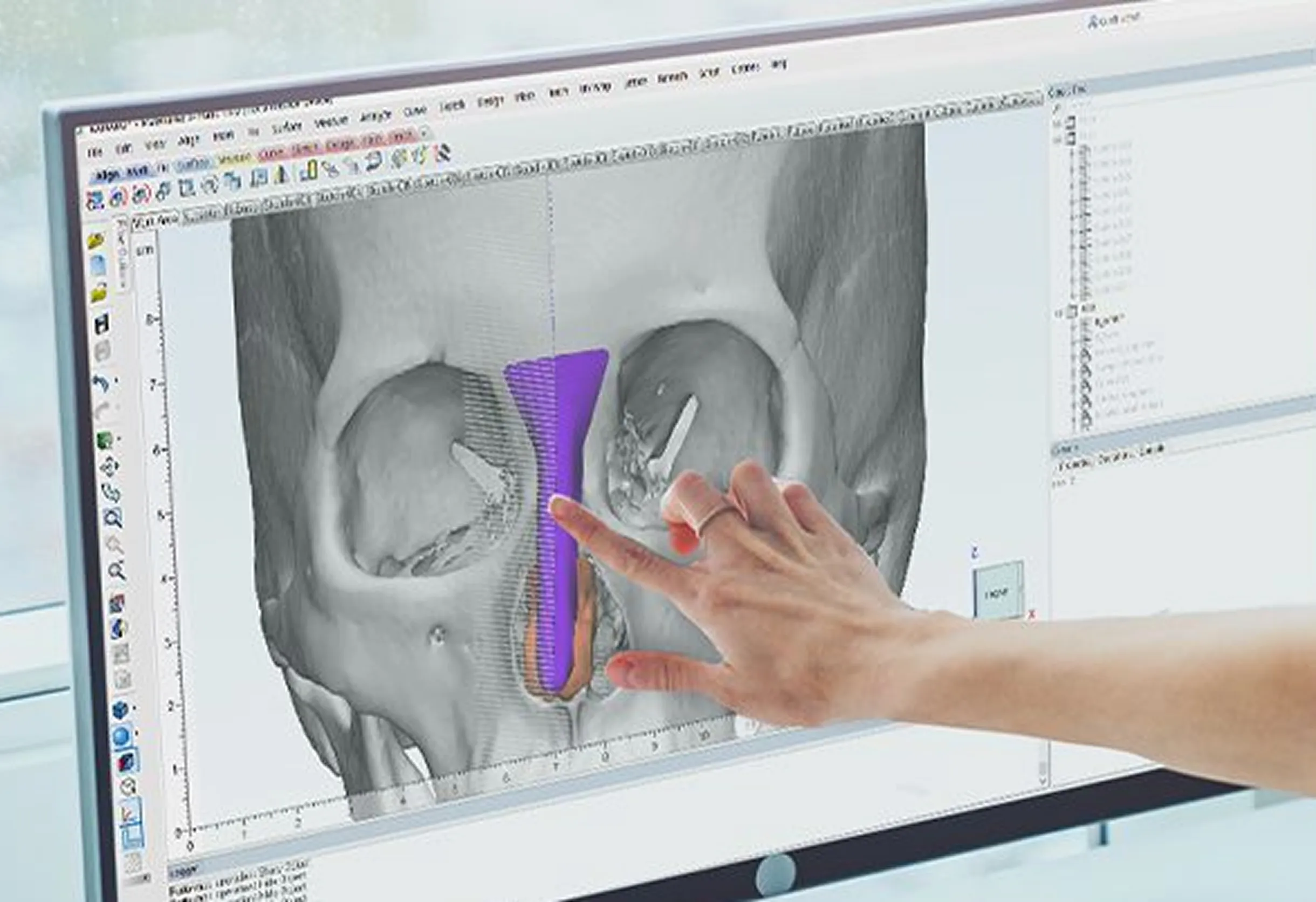 เสริมจมูก Vectra 3D Imaging Design