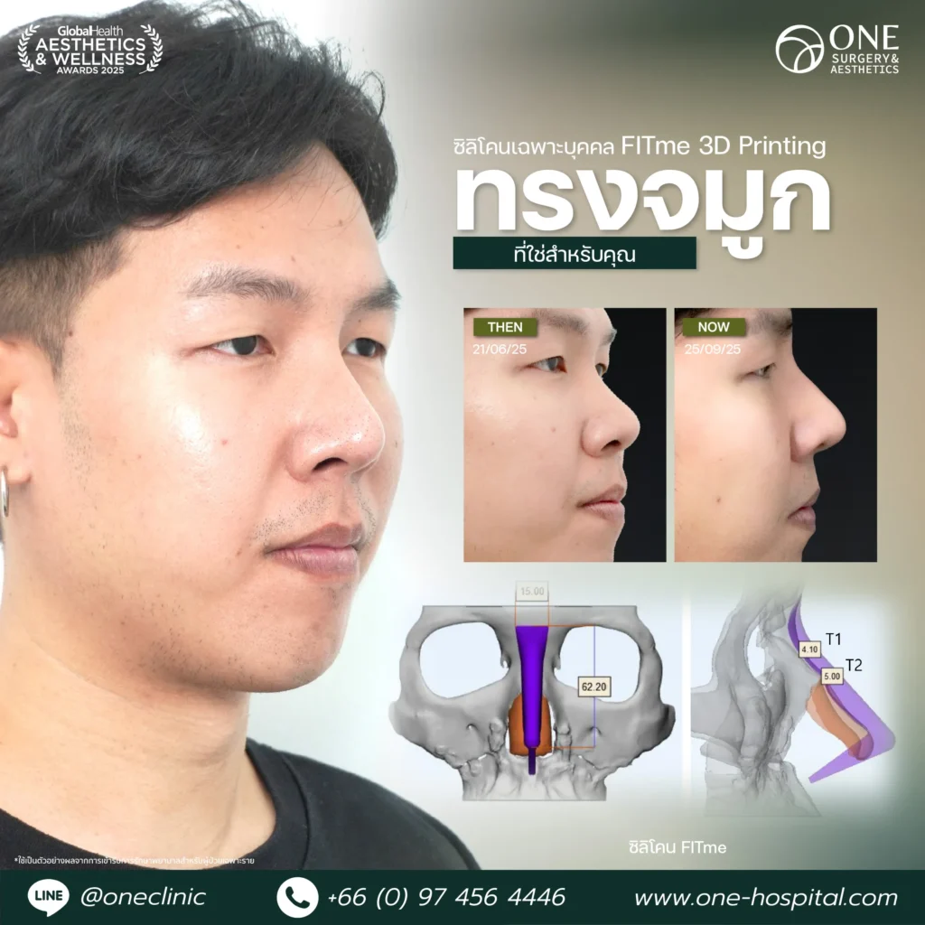 1 แทมเพลลตรีวิวจมูก_เธียร