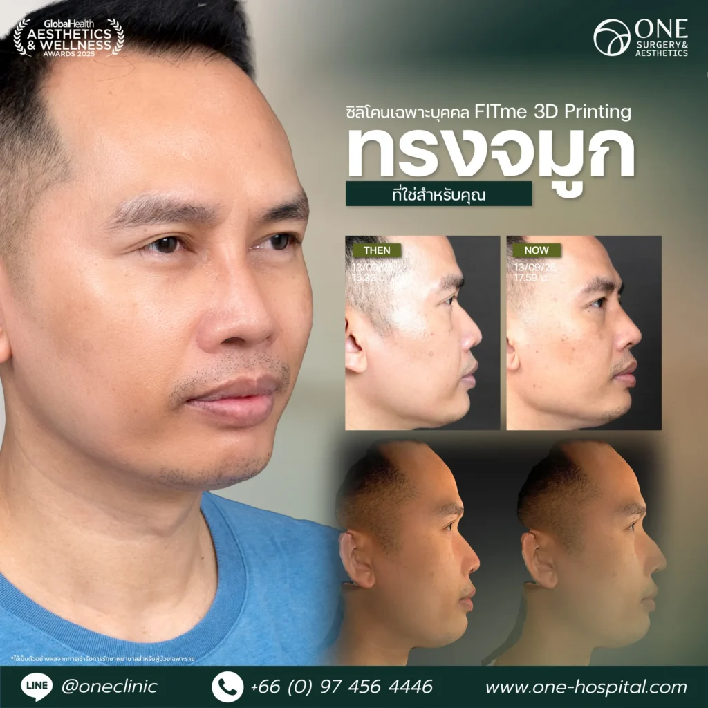 2แทมเพลลตรีวิวจมูก_ชาญ