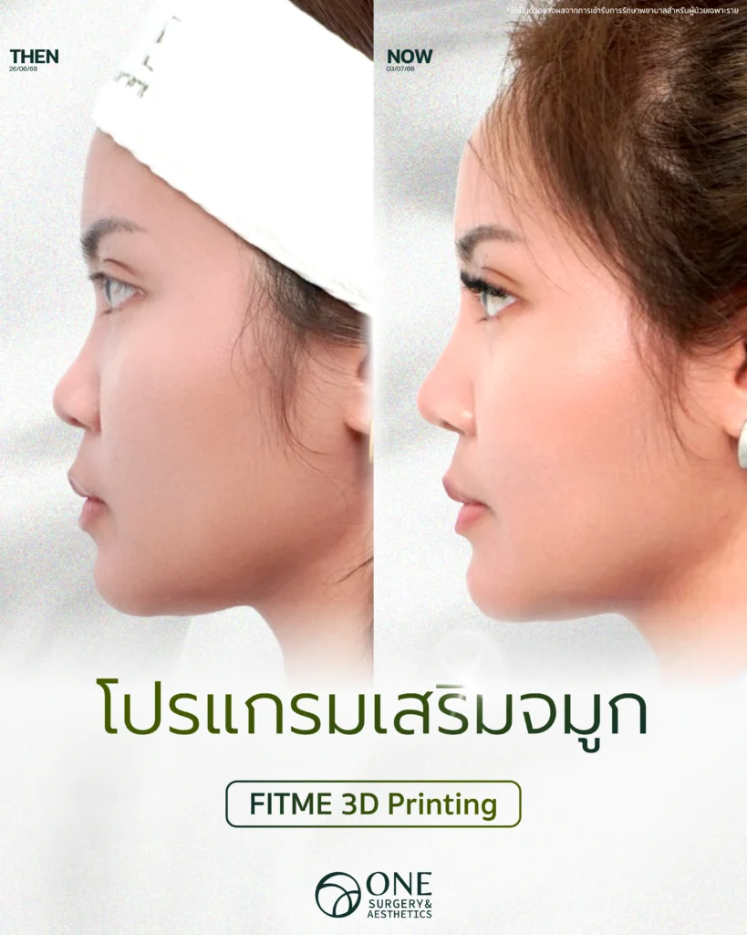 เสริมจมูก