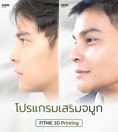 3D Design เสริมจมูก