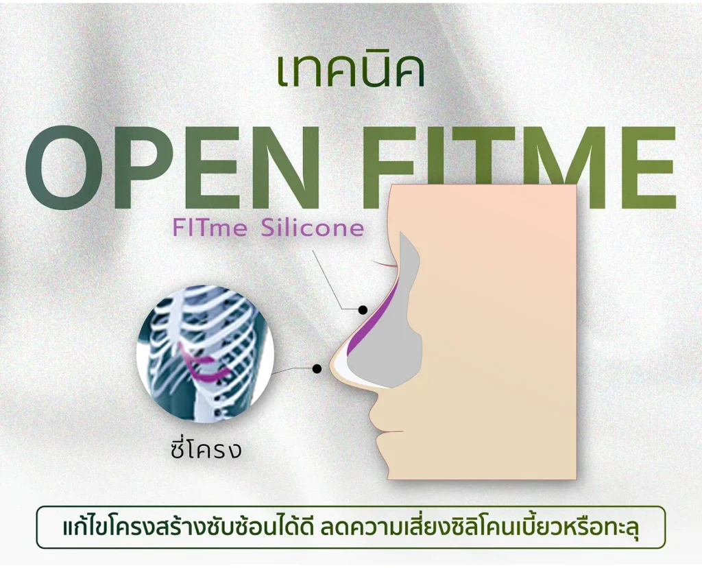 Open Reconstruction Rhinoplasty