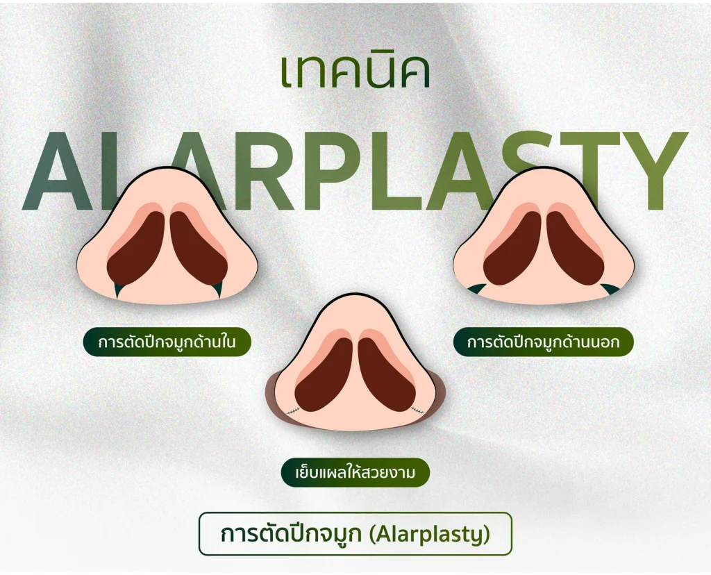 การตัดปีกจมูก (Alarplasty)