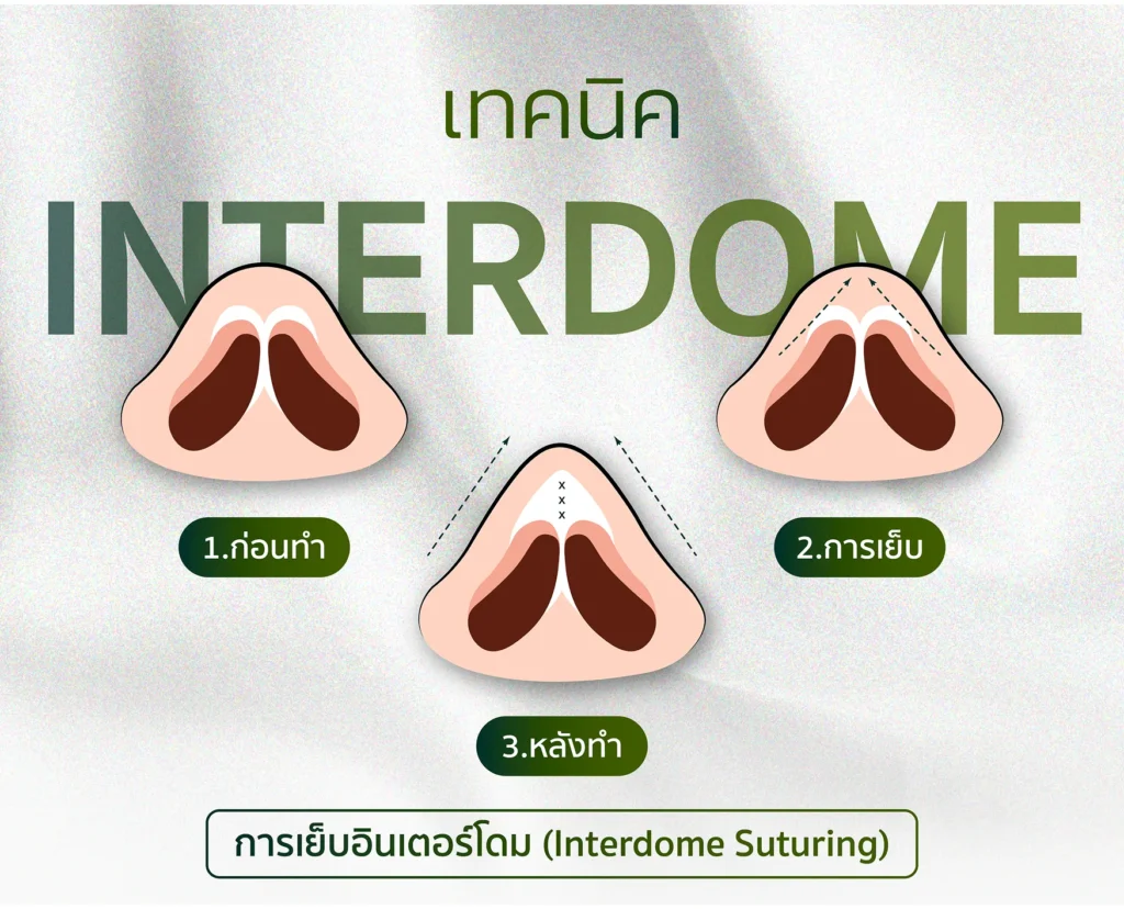 การเย็บอินเตอร์โดม (Interdome Suturing)