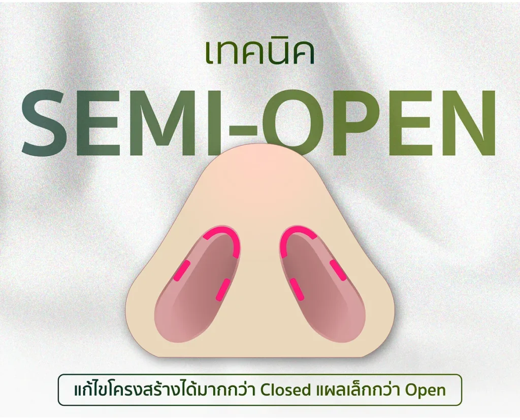 การเสริมจมูกแบบกึ่งเปิด (Semi-Open Rhinoplasty)