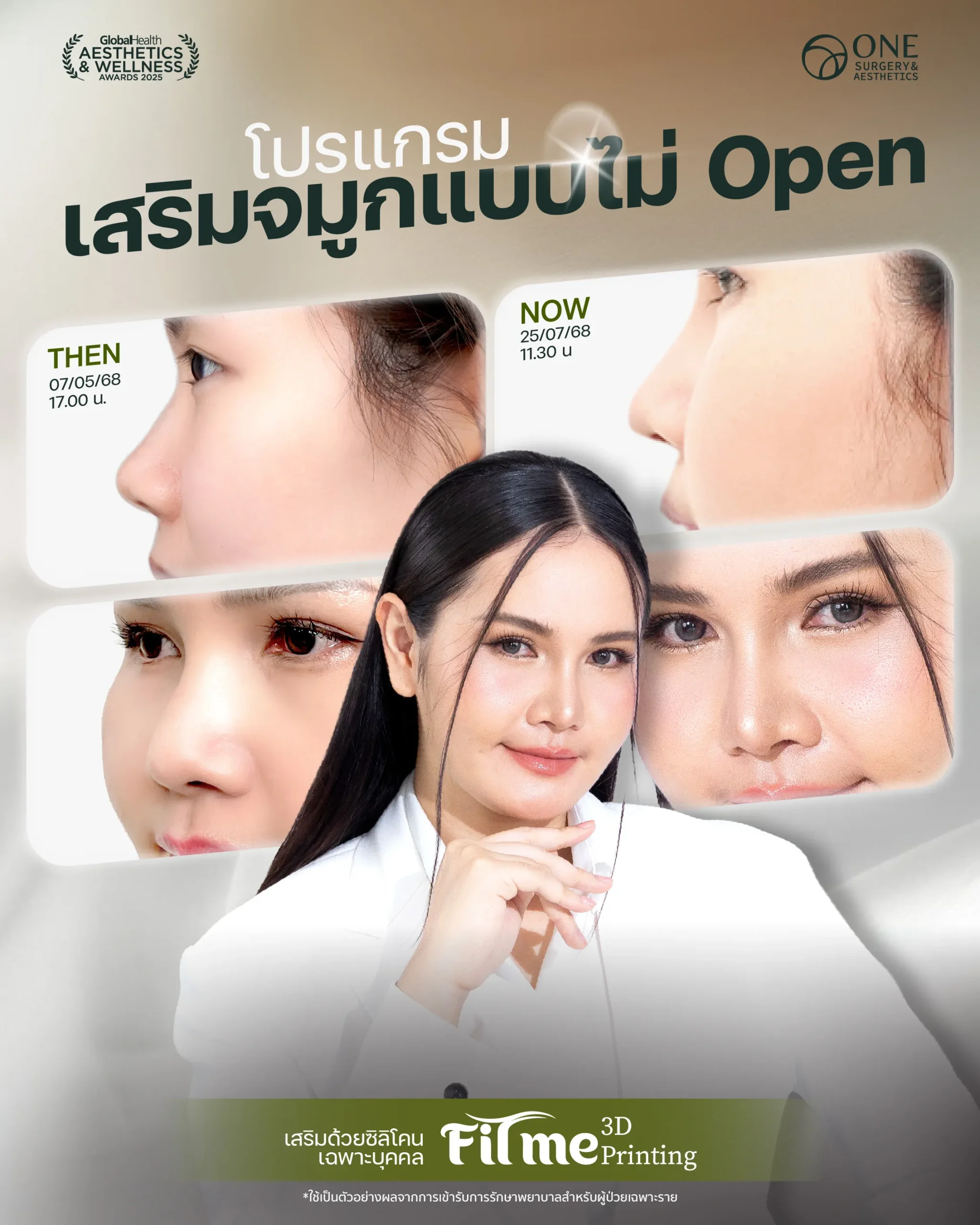 เสริมจมูก