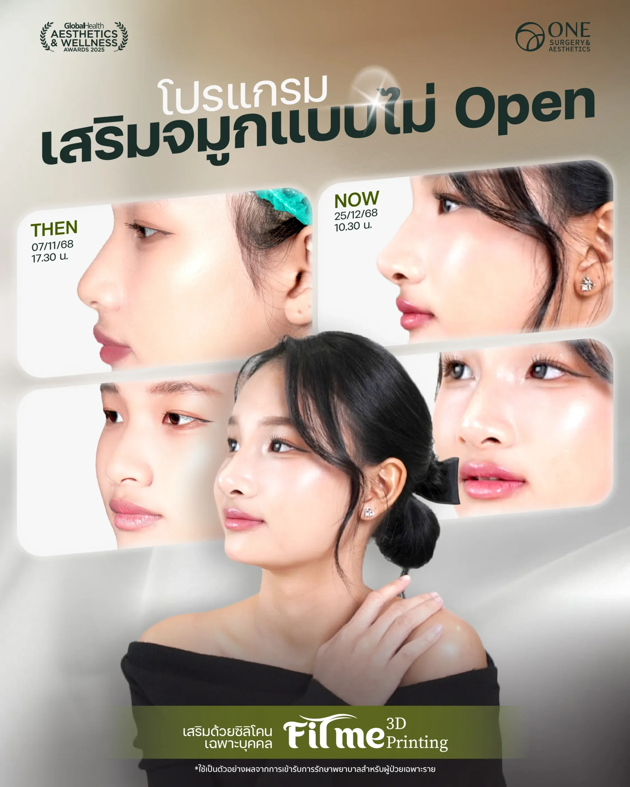 เสริมจมูก