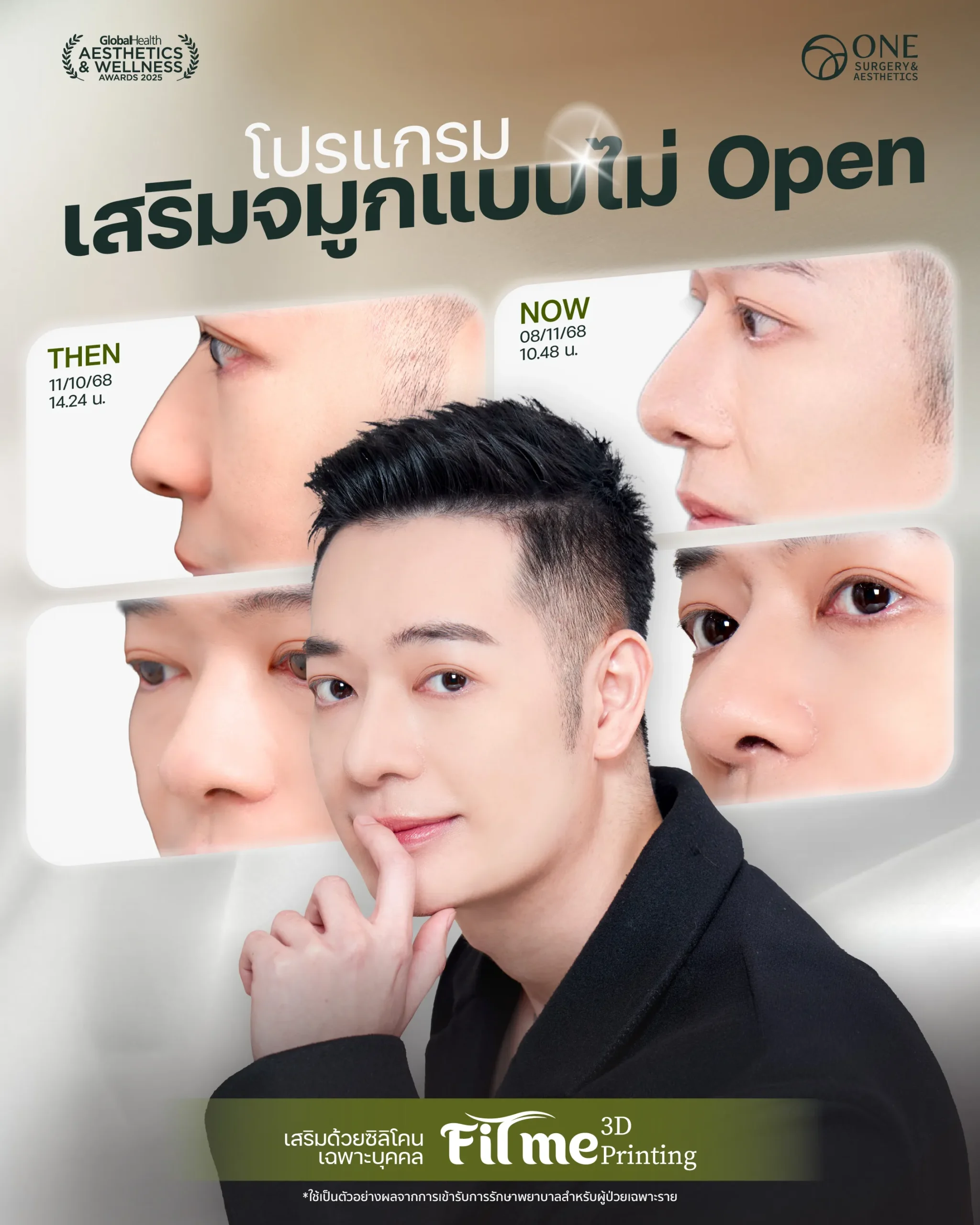 เสริมจมูก