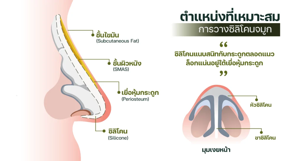 ตำแหน่งการวางซิลิโคน