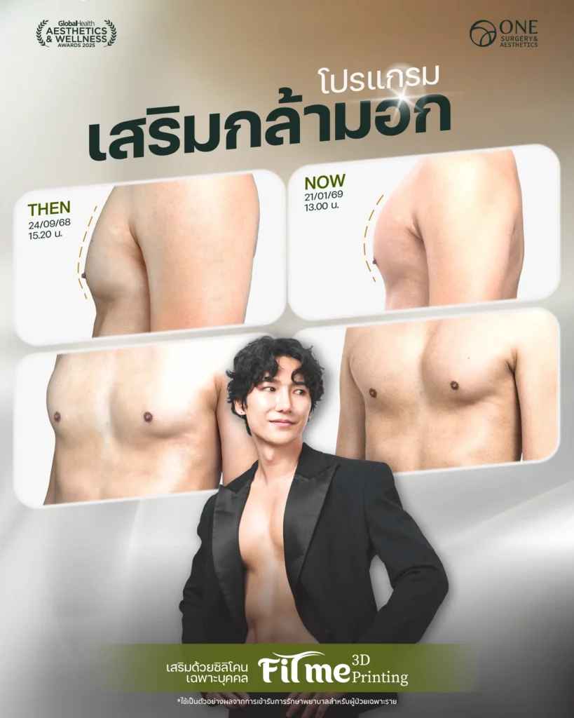 รวมรีวิว เสริมกล้ามอก Web-02
