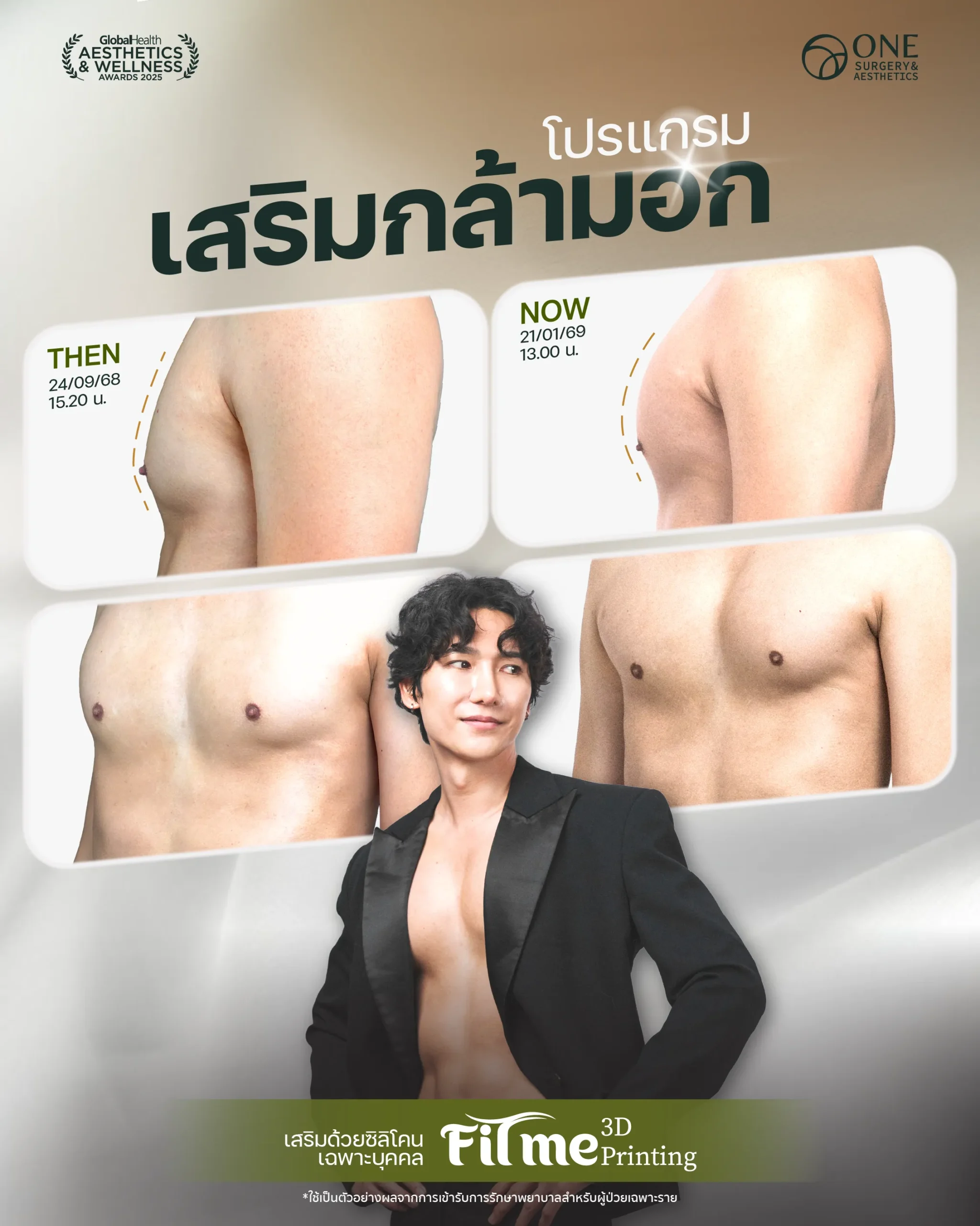 รวมรีวิว เสริมกล้ามอก Web-02