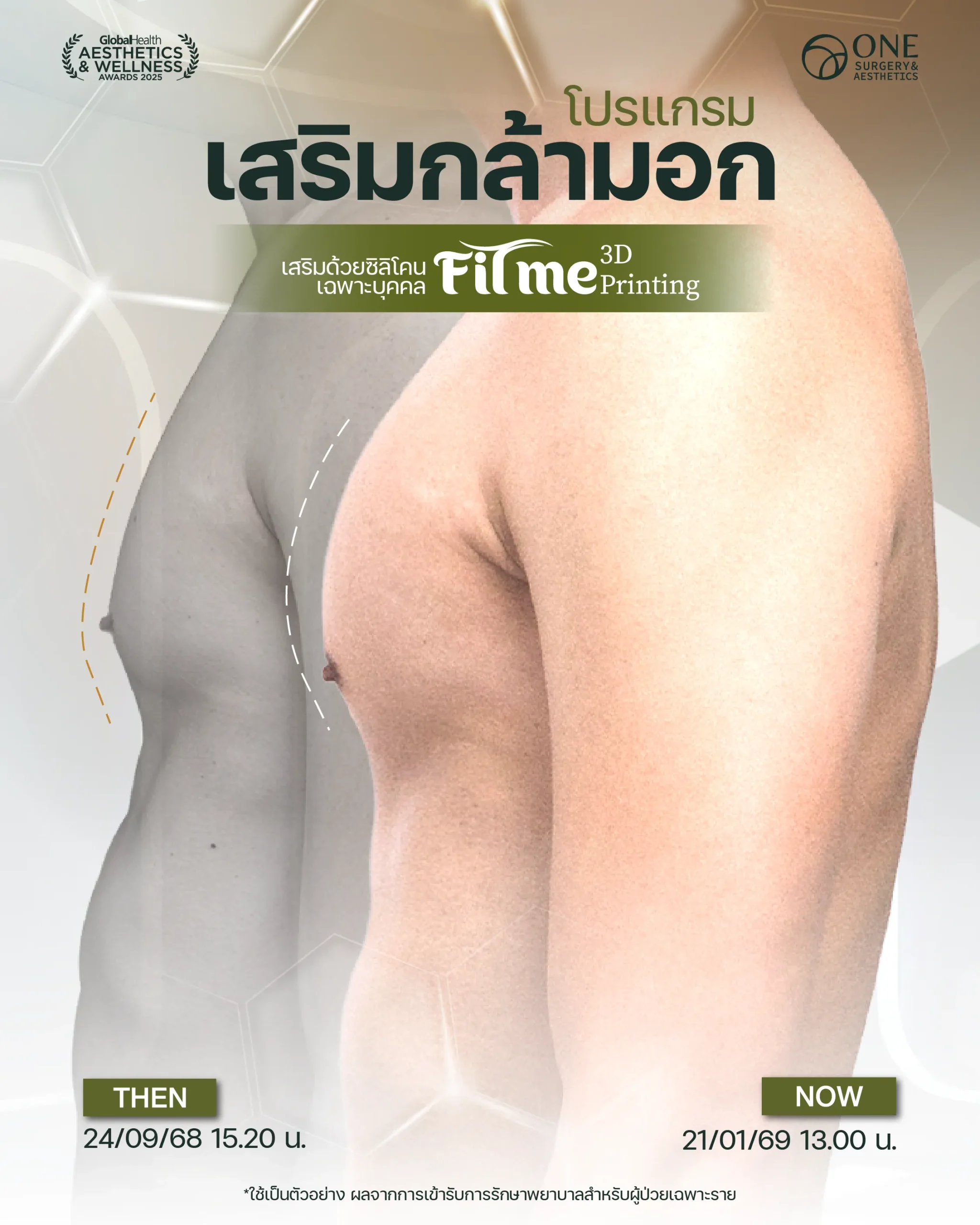รวมรีวิว เสริมกล้ามอก Web-03