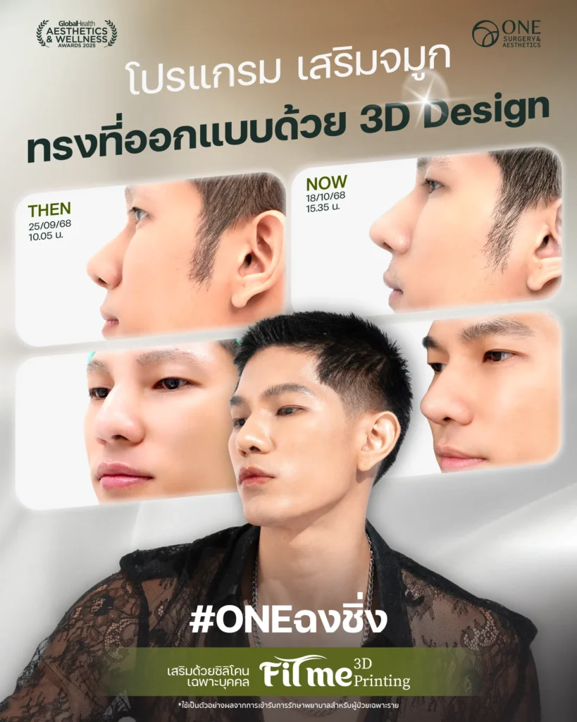 รวมรีวิว เสริมจมูก 6 ภาพใหญ่ Web_แมน_3