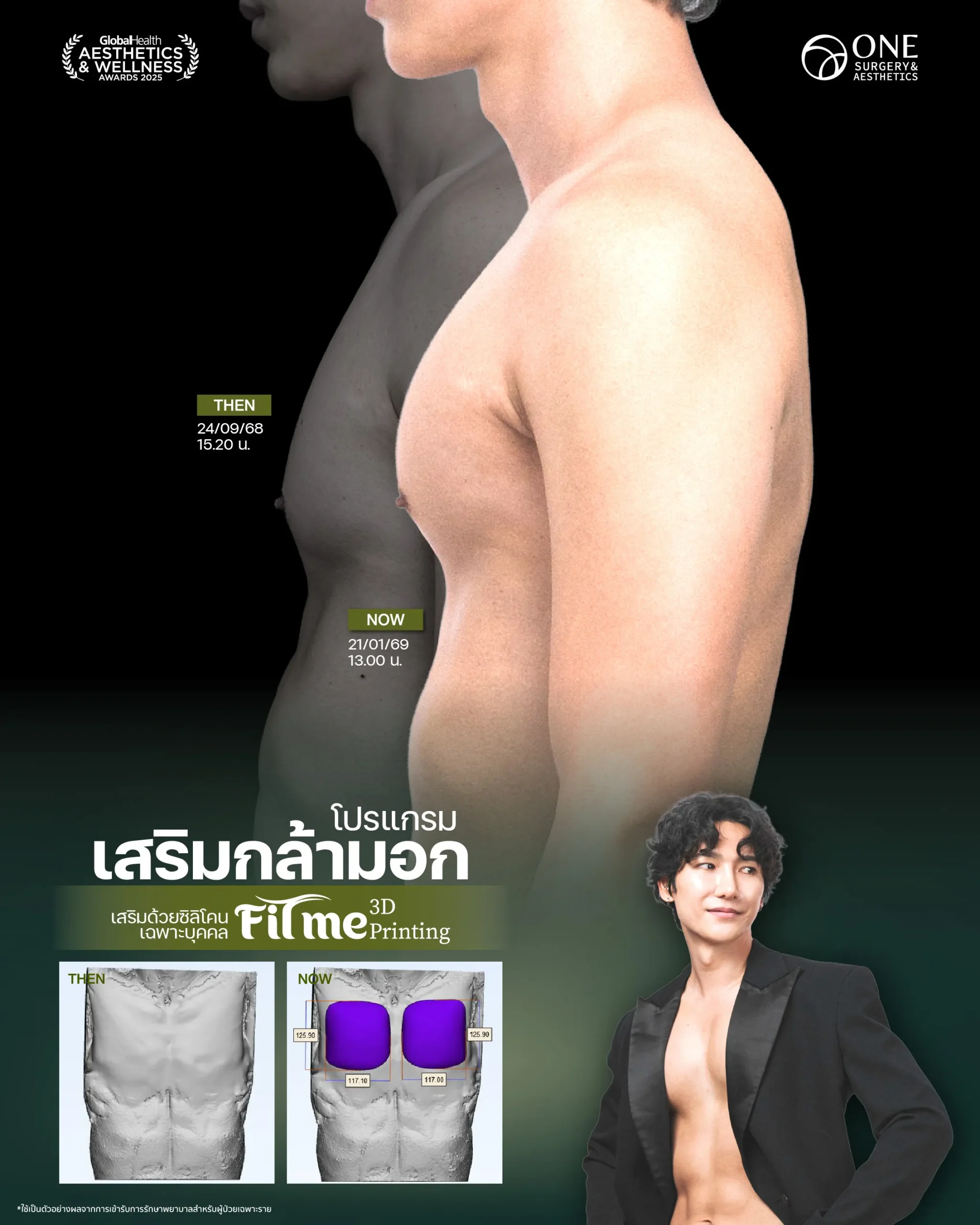 รีวิวกล้ามหน้าอก_ทอมมี่