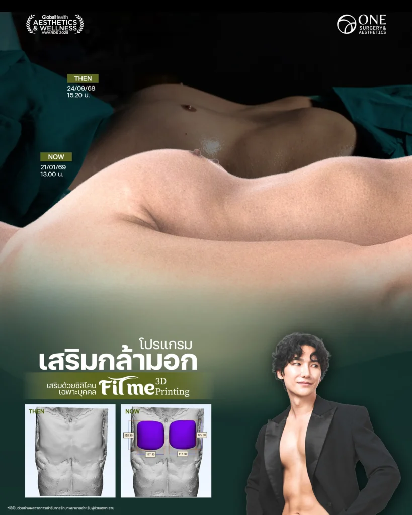 เสริมกล้ามอก