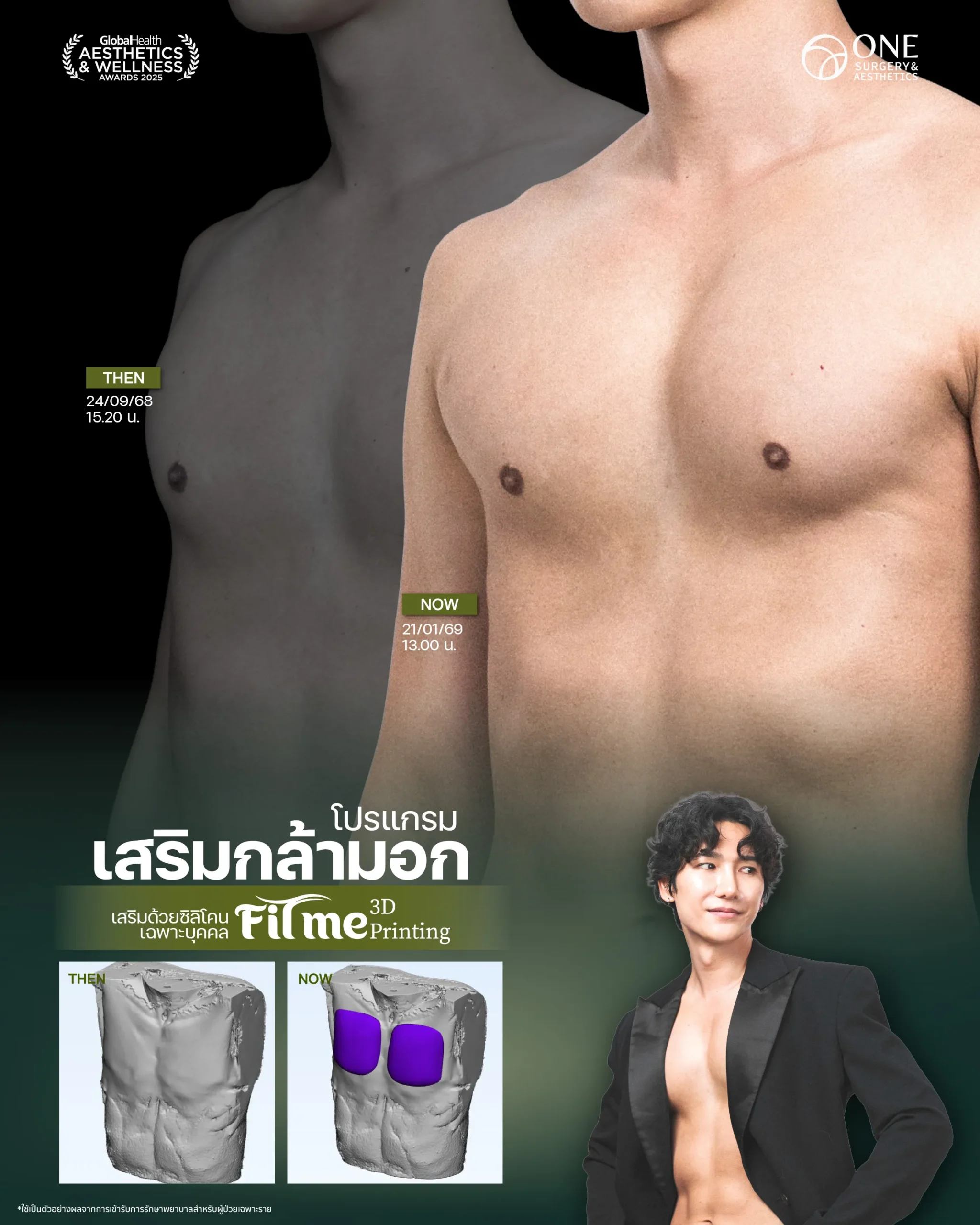 เสริมกล้ามอก