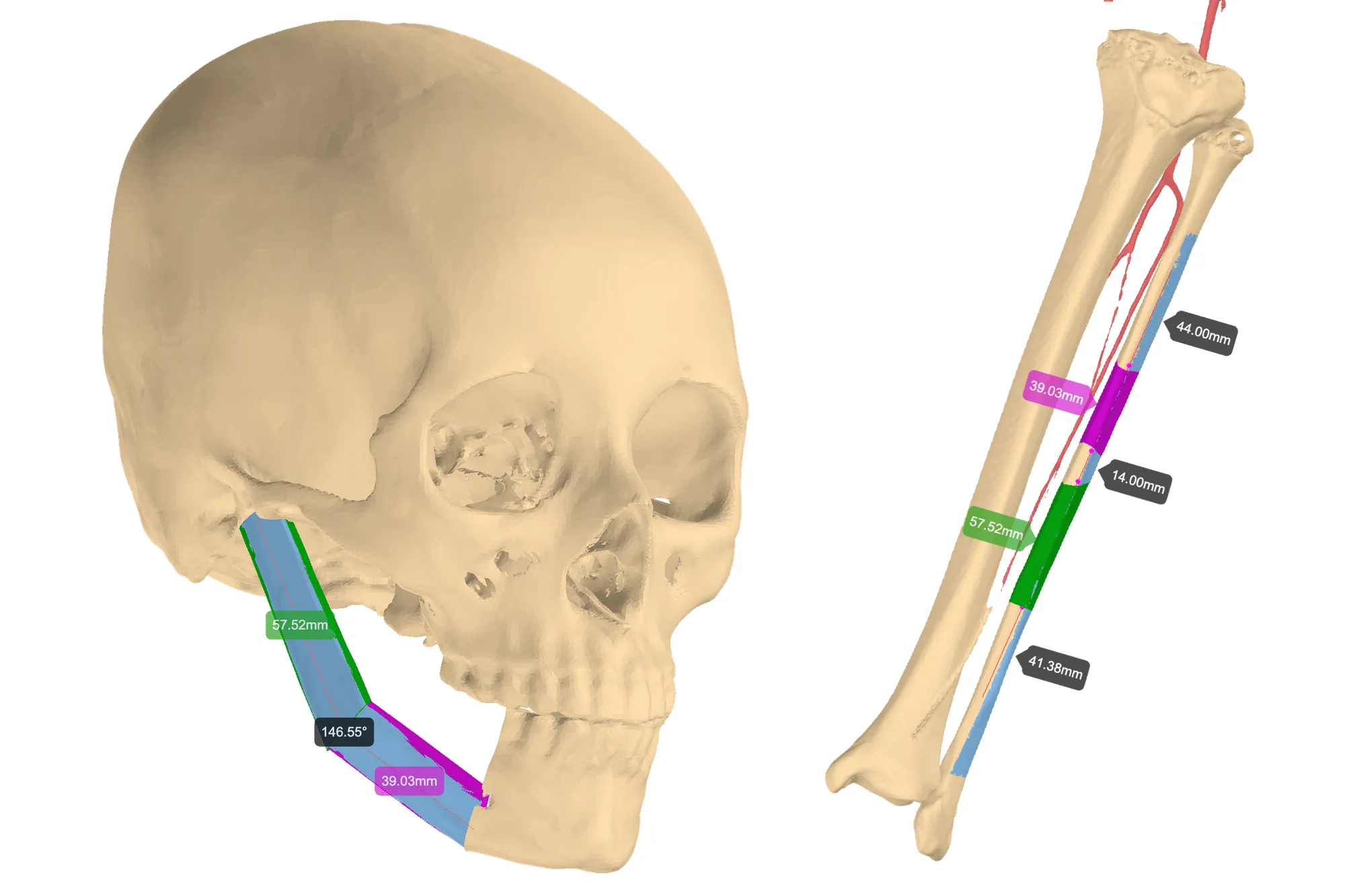 Mandibular Angle_11zon