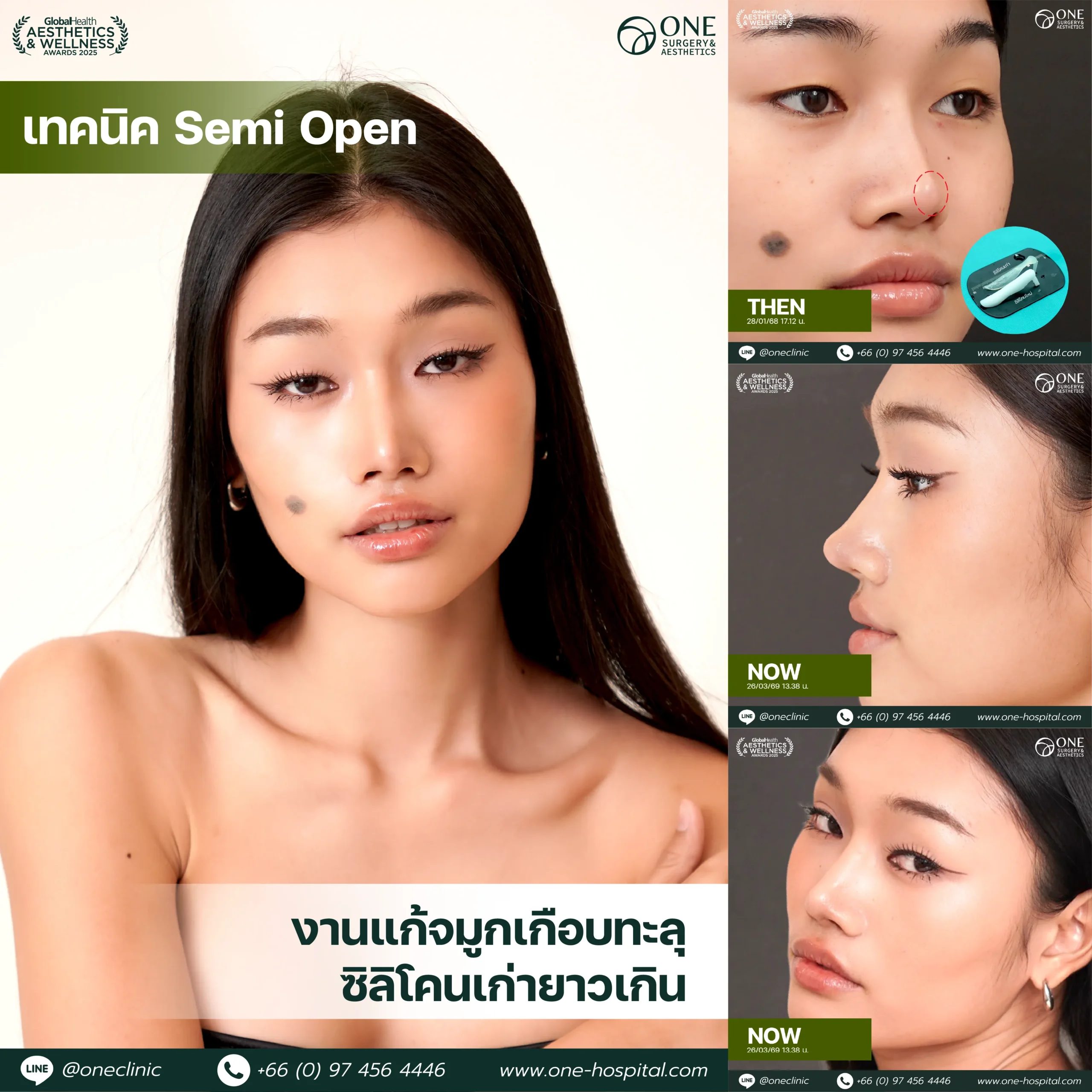 รวมรีวิว เสริมจมูก Web รวมหน้า-02 (1)_2