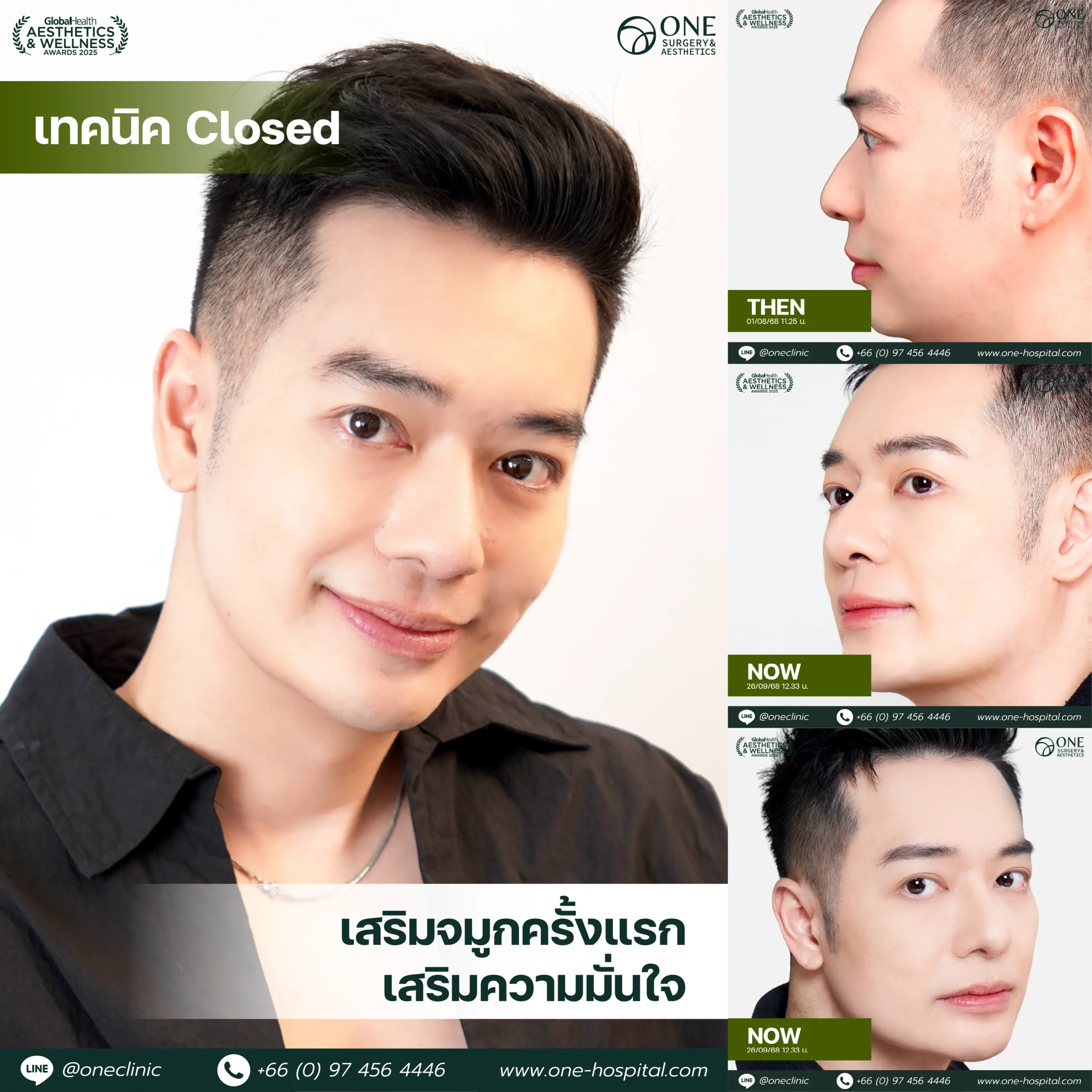 รวมรีวิว เสริมจมูก Web รวมหน้า-05_12