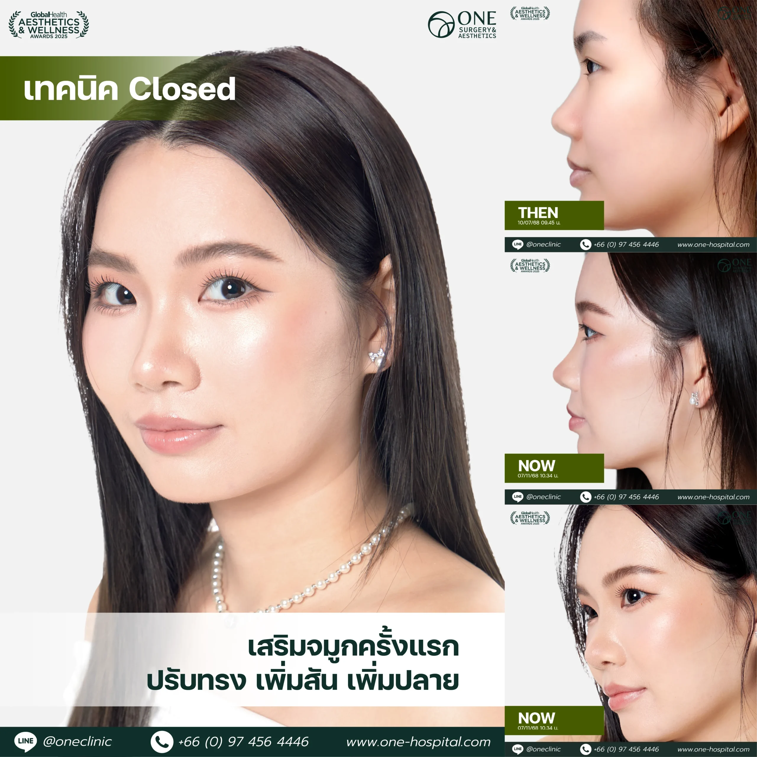 รวมรีวิว เสริมจมูก Web รวมหน้า-06_11