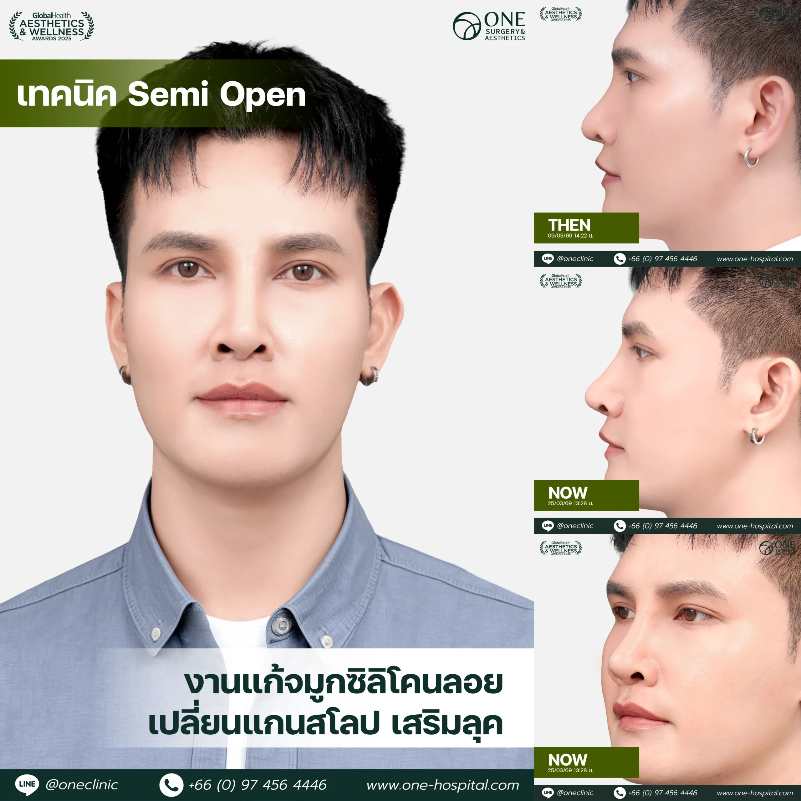 รวมรีวิว เสริมจมูก Web รวมหน้า-07_10