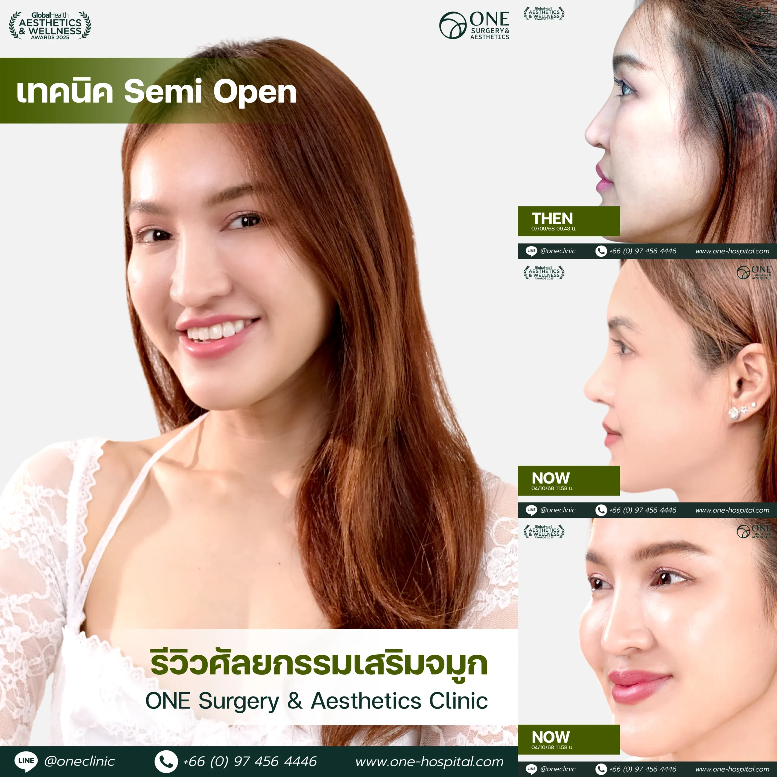 รวมรีวิว เสริมจมูก Web รวมหน้า-09_8