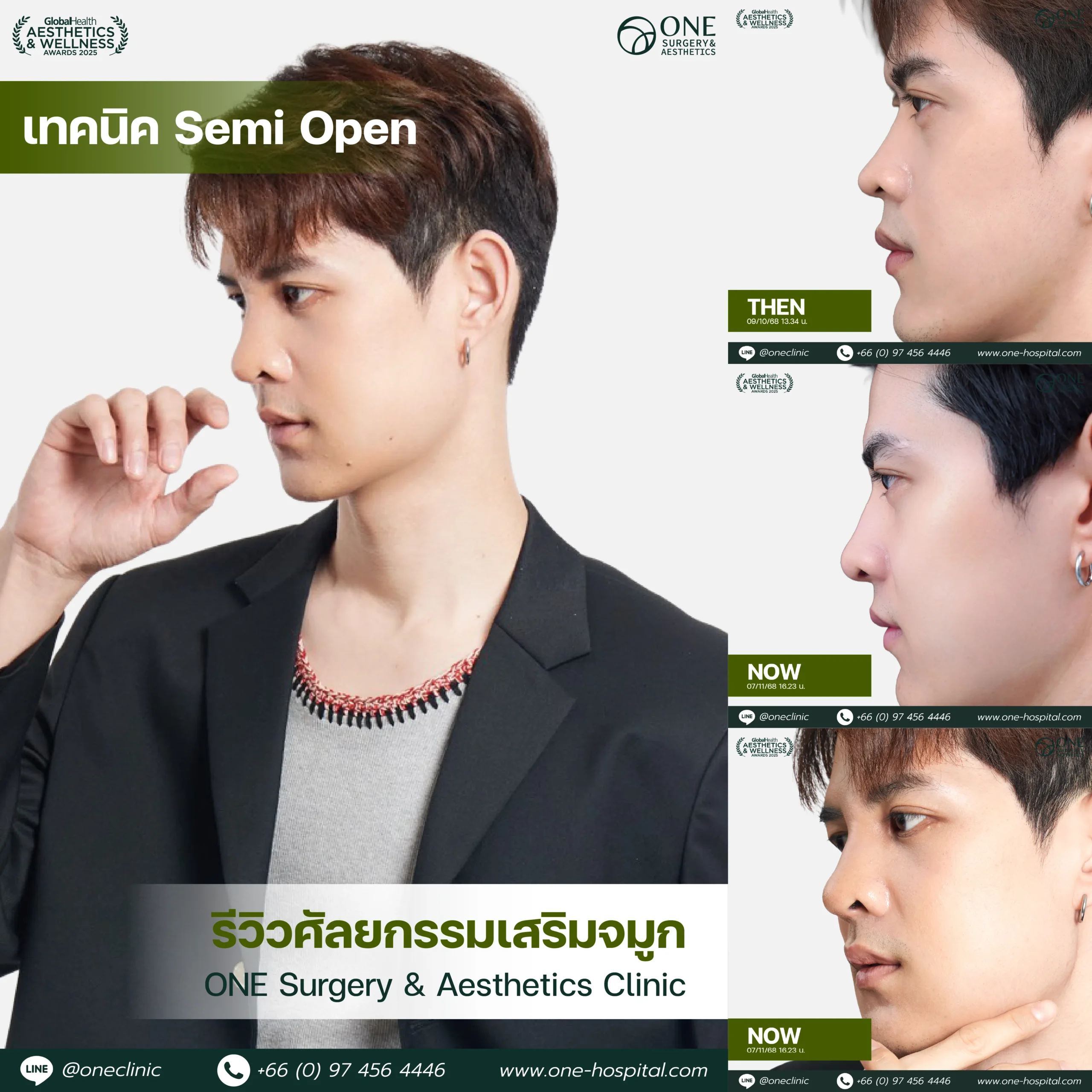 รวมรีวิว เสริมจมูก Web รวมหน้า-10_7