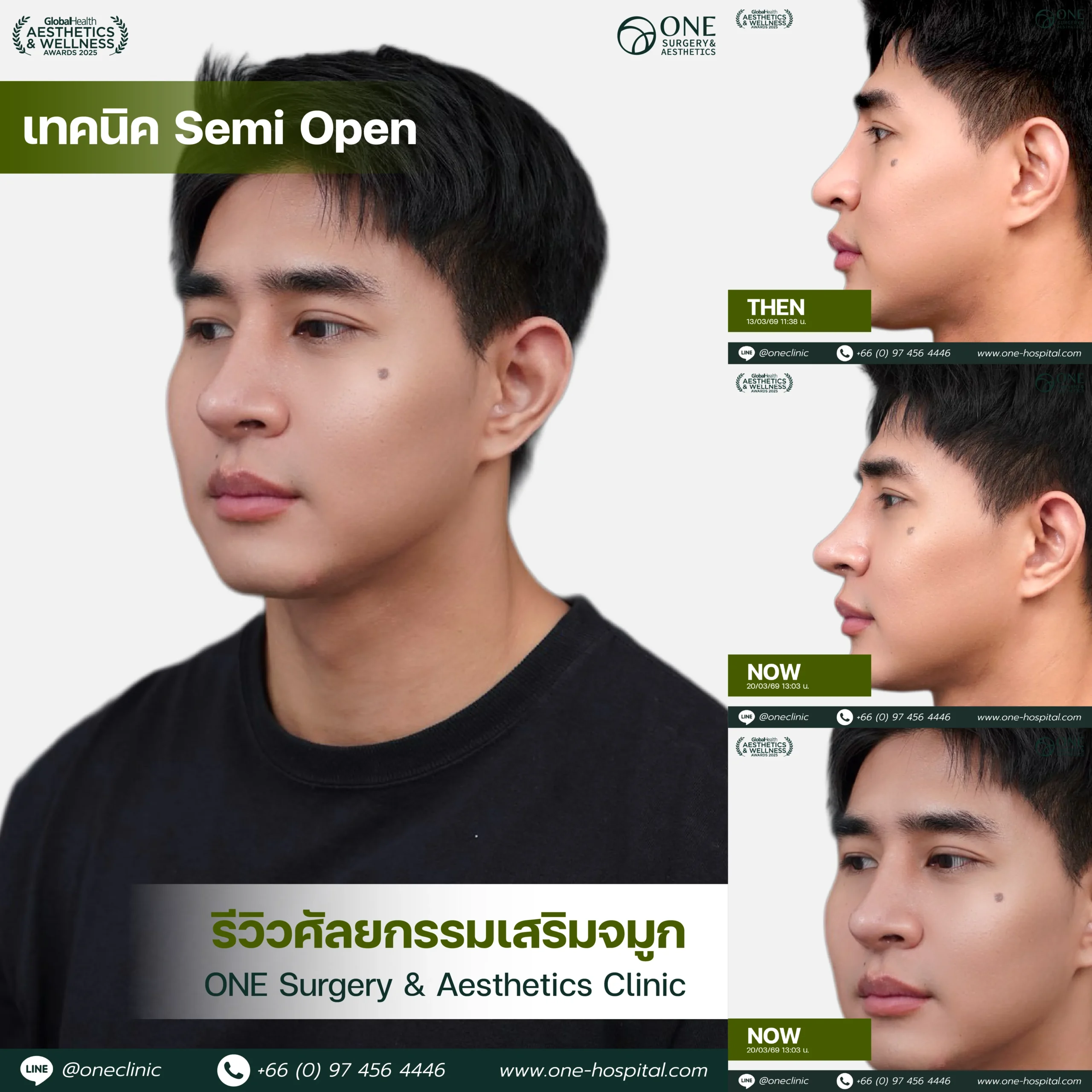 รวมรีวิว เสริมจมูก Web รวมหน้า-11_6
