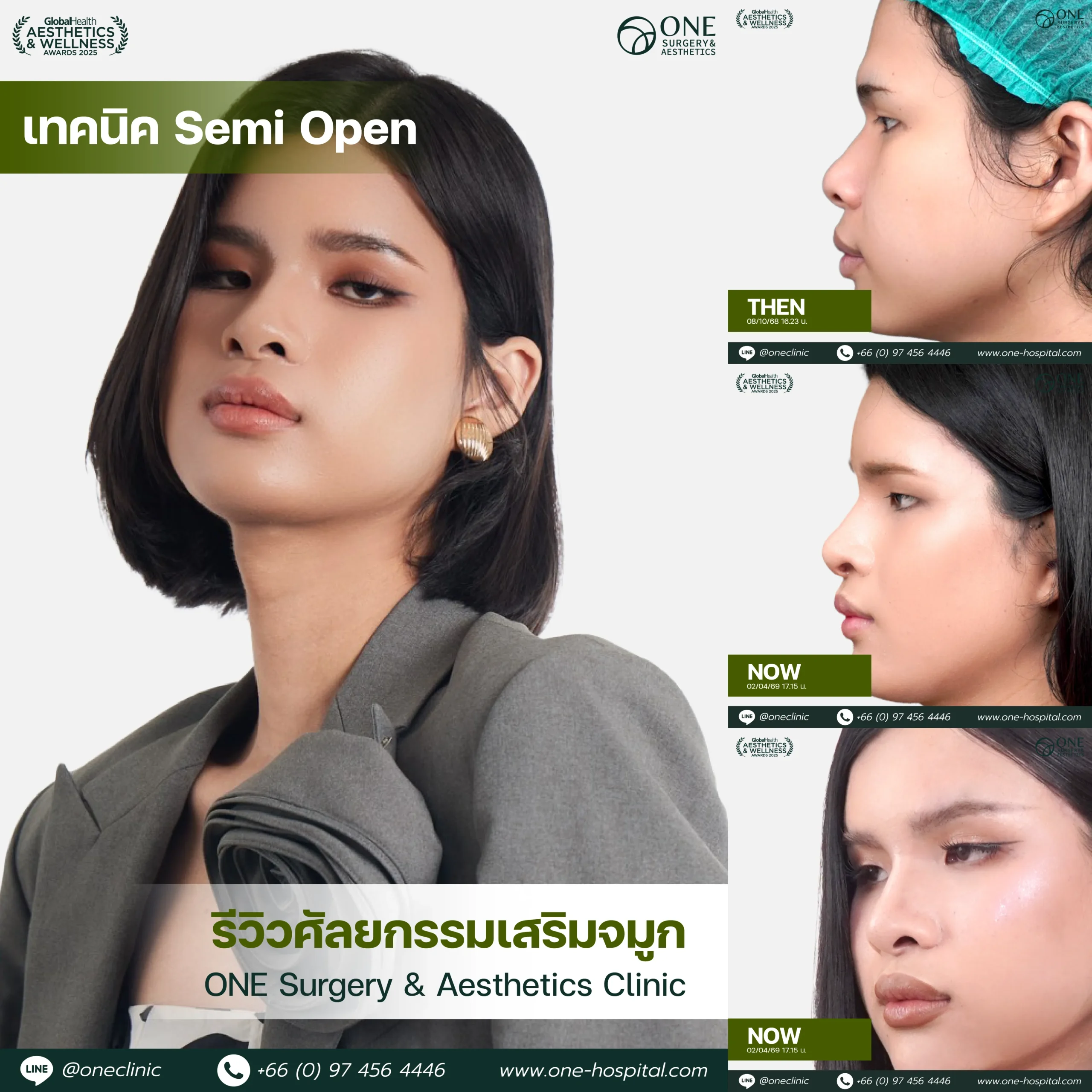 รวมรีวิว เสริมจมูก Web รวมหน้า-12_5