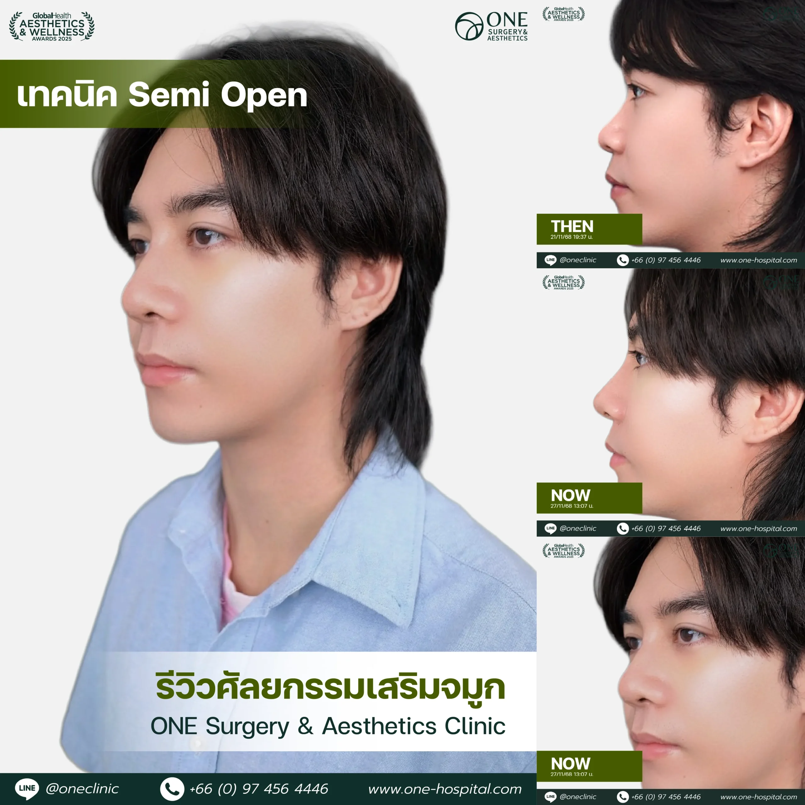 รวมรีวิว เสริมจมูก Web รวมหน้า-13_4