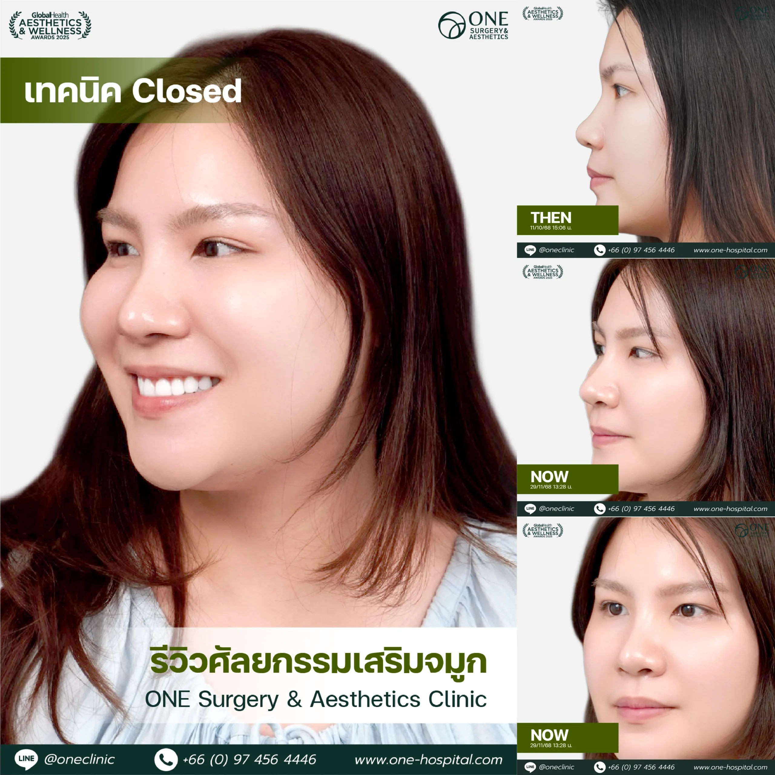 รวมรีวิว เสริมจมูก Web รวมหน้า-14_3