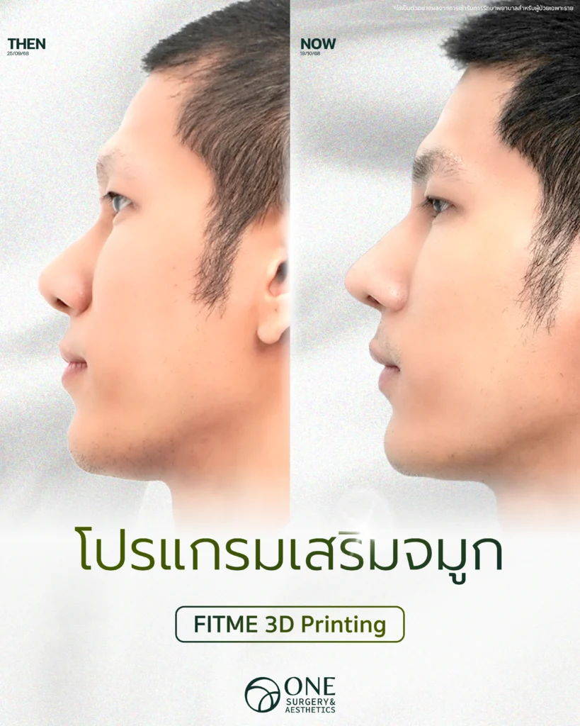 เสริมจมูก