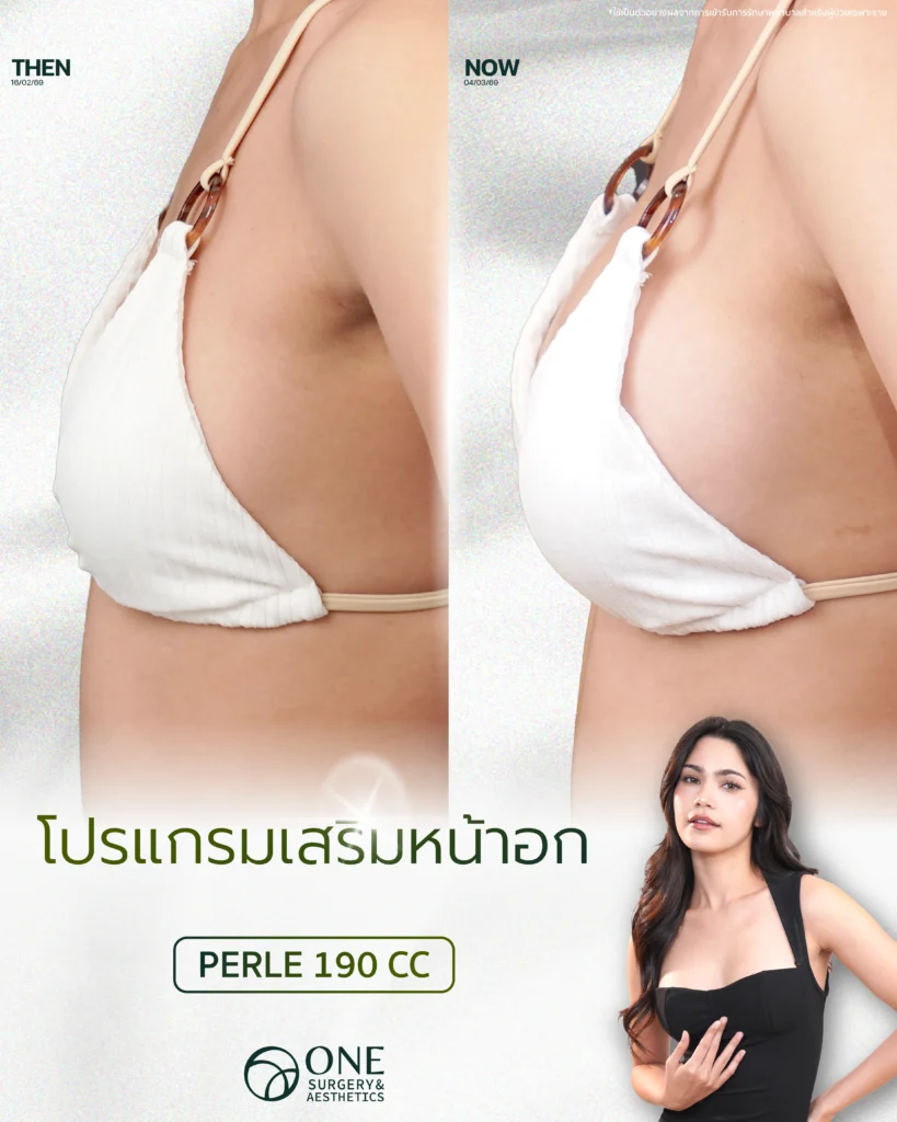 เสริมหน้าอก