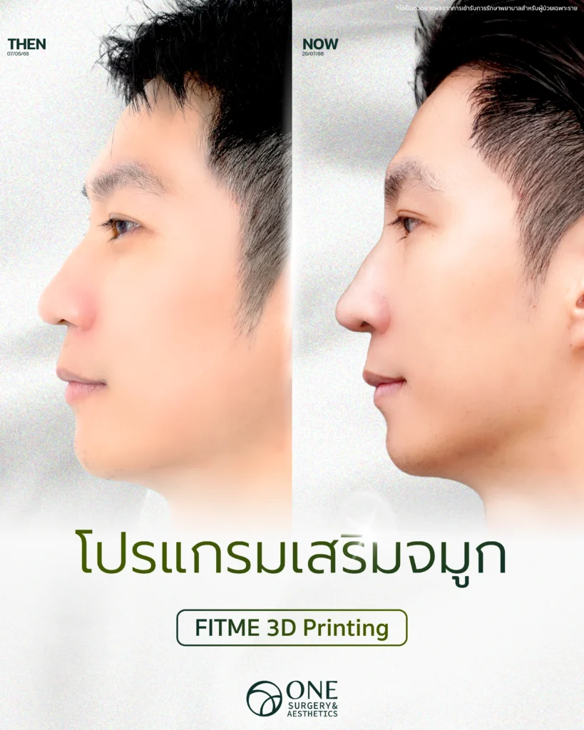 เสริมจมูก