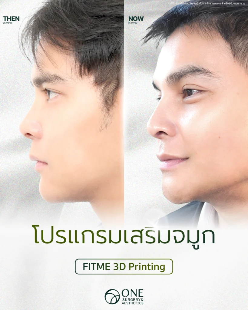 เสริมจมูก