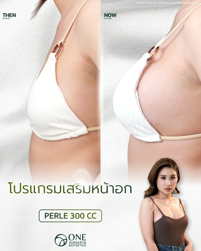 เสริมหน้าอก