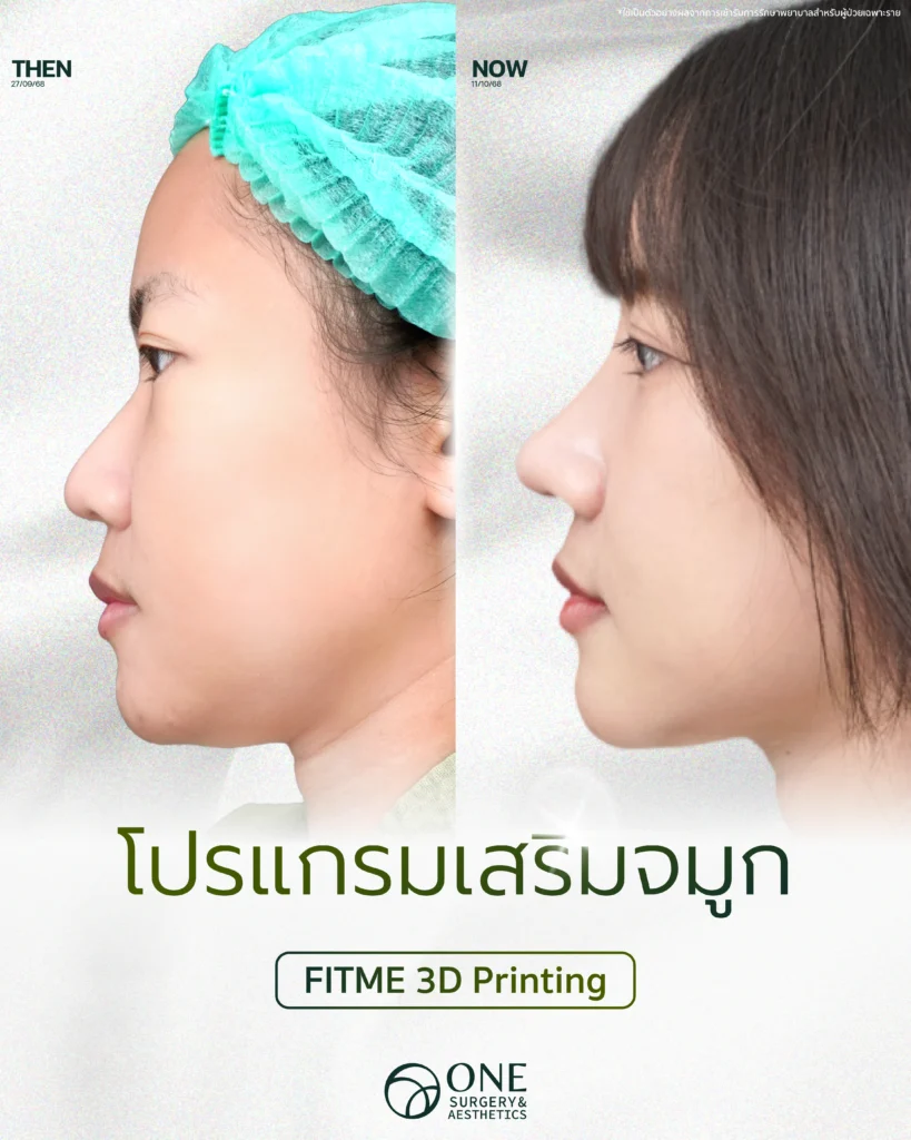 เสริมจมูก