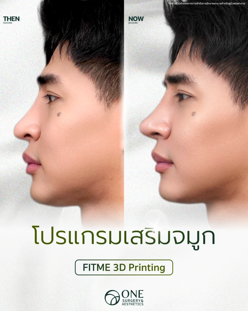 เสริมจมูก