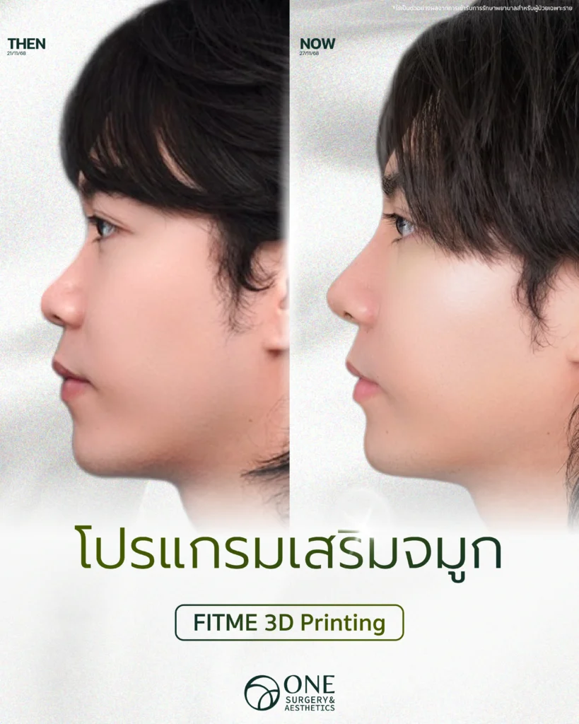 เสริมจมูก