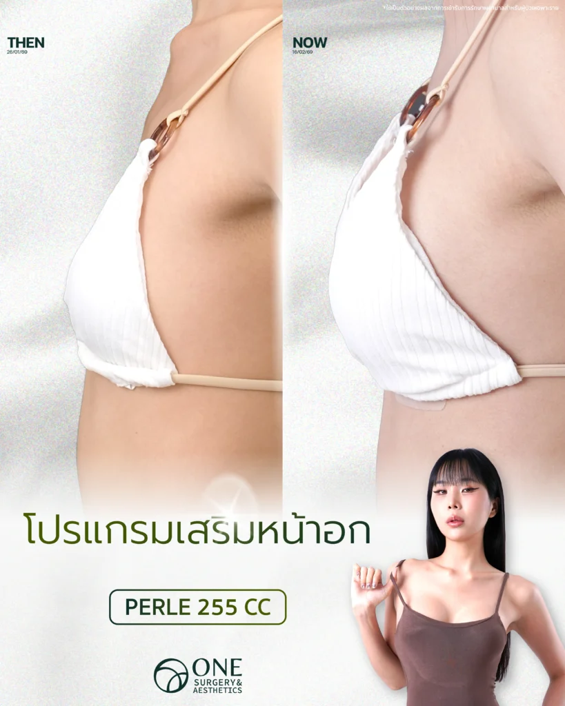 เสริมหน้าอก