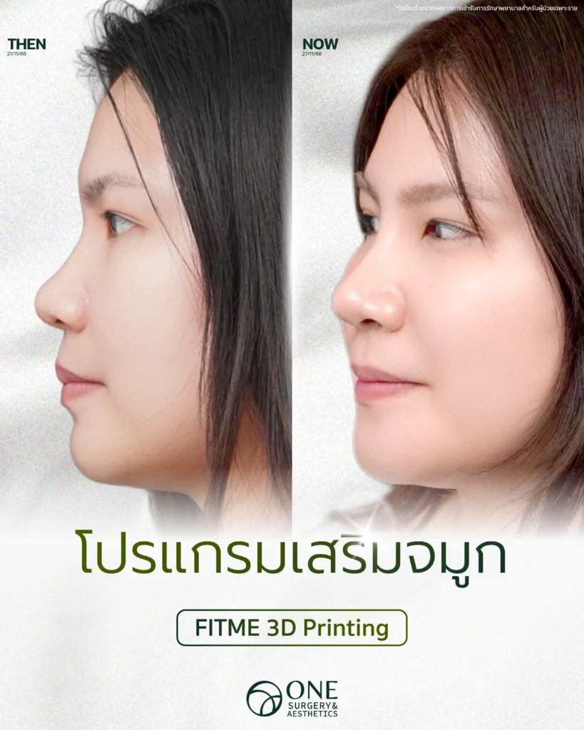 เสริมจมูก